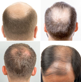 photos of hair loss