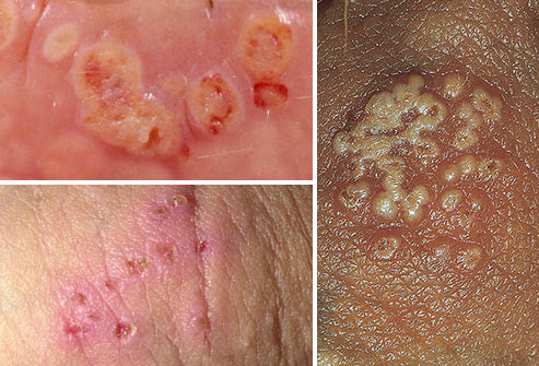Photos of herpes blisters