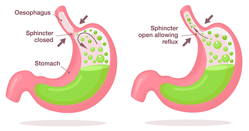 illustration of acid reflux