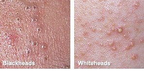 blackheads and spots