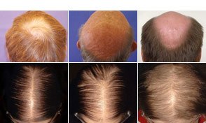 photos of hair loss