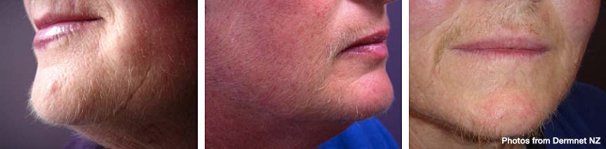 Hirsutism and Vaniqa: Frequently Asked Questions - Dr Fox
