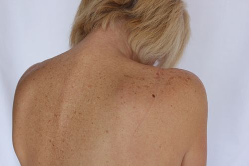 How to Treat Red Bumps on Arms Naturally - The Greenbacks Gal