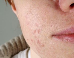 adult acne