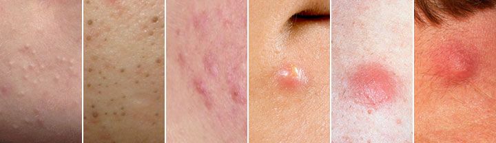 Different types of spots and how to treat acne - Dr Fox