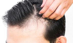 Man with male pattern hair loss
